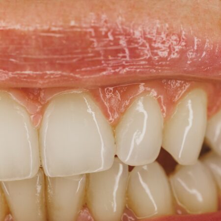 Natural Teeth Remineralization